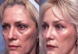 Retinoic Acid Powder Functions